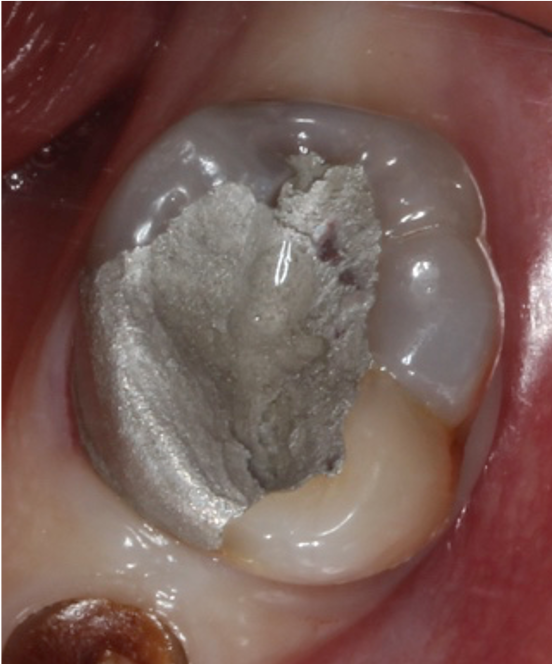 Root Canal Treatment AtoothZ